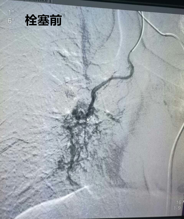 栓塞前.png 栓塞前.png