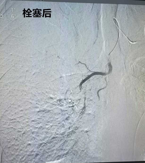 栓塞后.png 栓塞后.png
