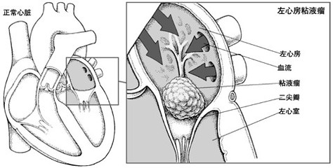 左心房粘液瘤.jpg