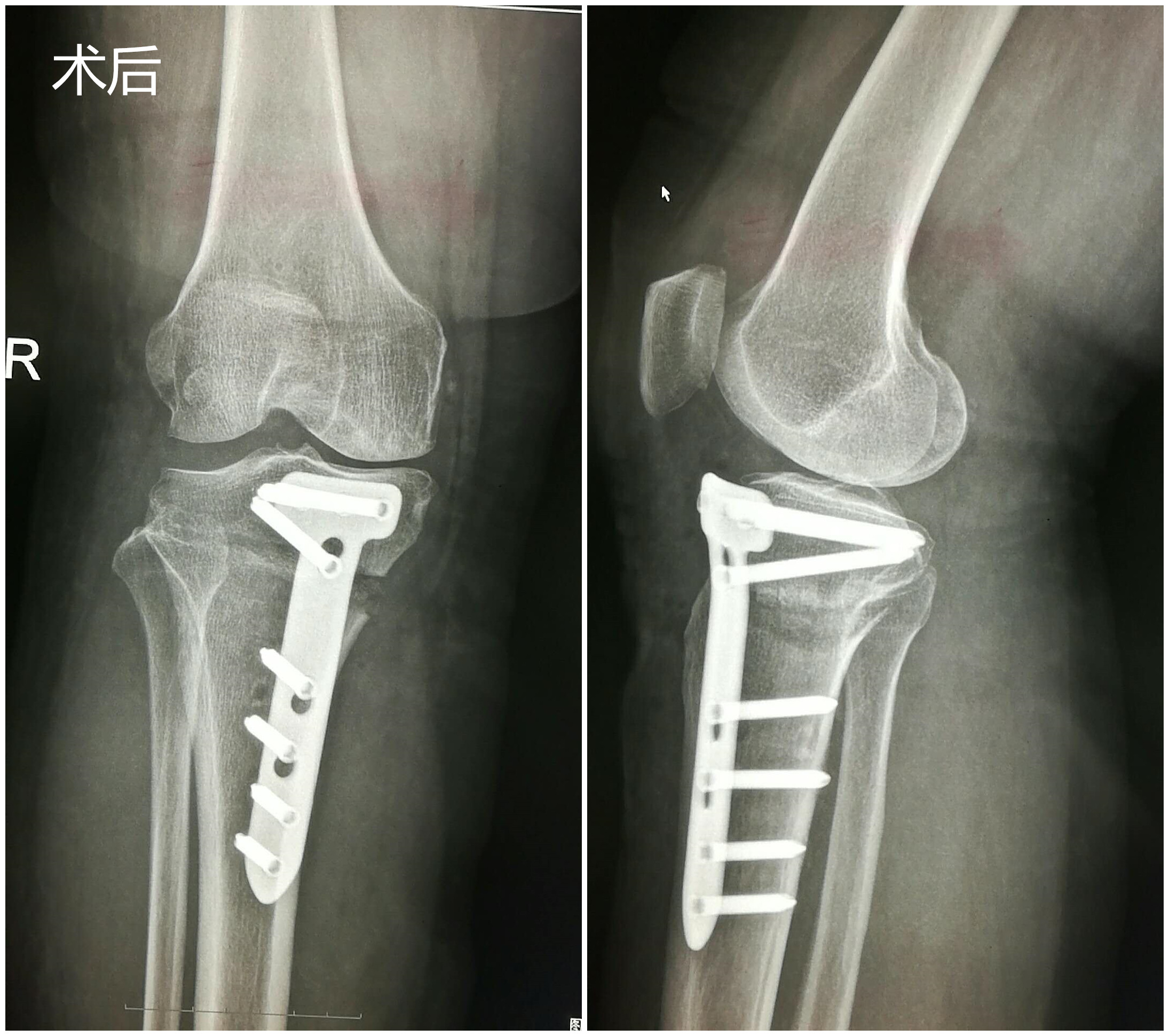 术后 (1)_副本.jpg 术后 (1)_副本.jpg