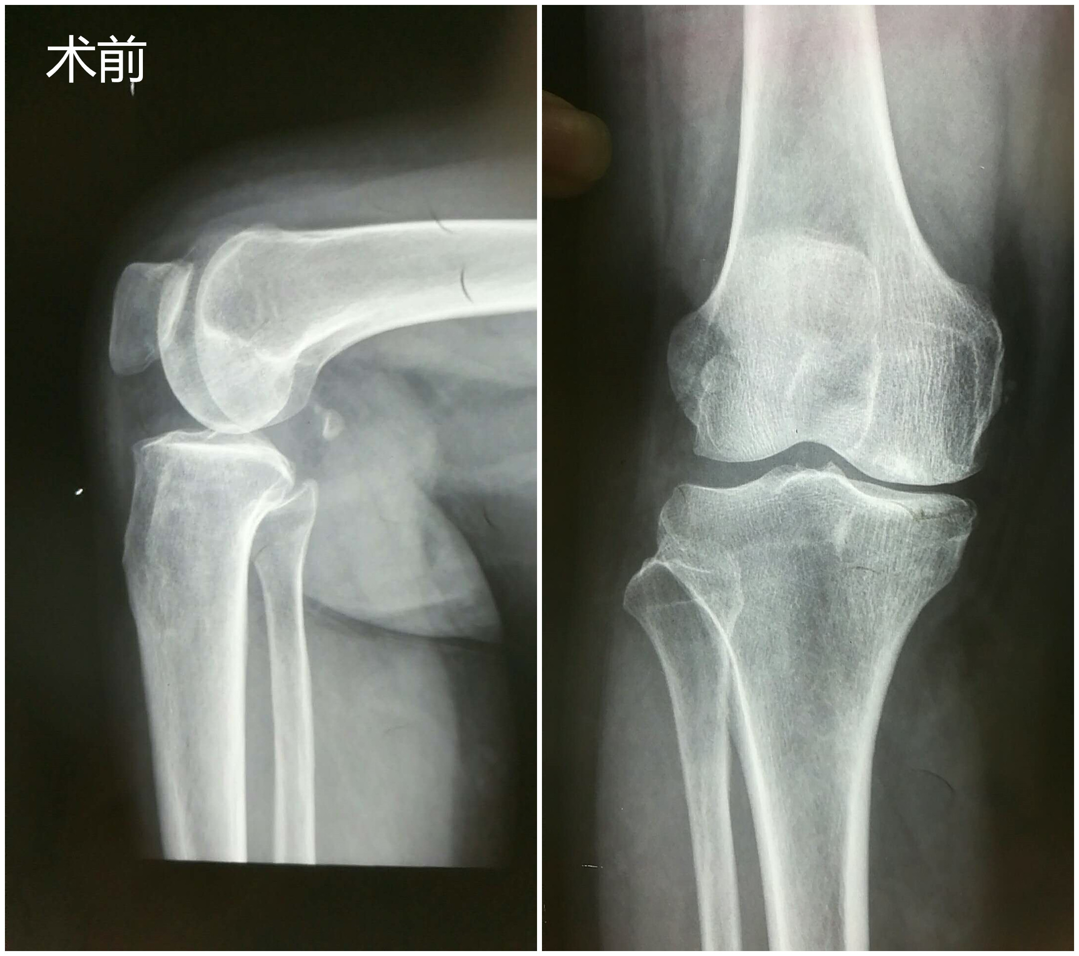 术前_副本.jpg 术前_副本.jpg